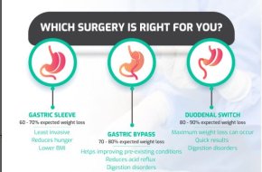 Ugale Bariatrics – Best bariatric and weight loss surgery hospital | Hyderabad