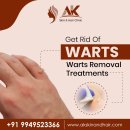 Say Goodbye to Warts with Safe & Simple Removal Treatments in Hyderabad
