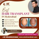 Best Hair Transplant Surgeon – Restore Your Confidence Today!