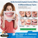 Best Dental Hospital in Secunderabad for Braces Treatment