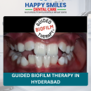 Guided Biofilm Therapy in Hyderabad