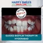 Guided Biofilm Therapy in Hyderabad