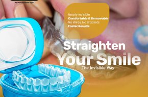 Invisalign in Secunderabad at Smile Dental and Implant Centre