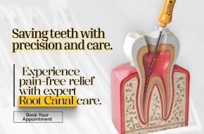 Best Root Canal Dental Clinic in AS Rao Nagar, Secunderabad.