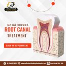 Best Root Canal Dental Clinic in Secunderabad