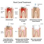 Painless Root Canal Dentist near Me | Pain-Free RCT Treatment