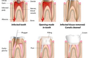 Painless Root Canal Dentist near Me | Pain-Free RCT Treatment