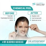 Get Radiant Skin with Advanced Pigmentation Treatment in Secunderabad