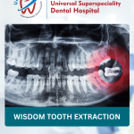 Wisdom Tooth Extraction: What to Expect & How to Prepare