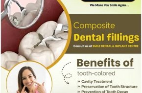Painless Way to Match Fillings with Your Teeth | Smile Dental and Implant Centre