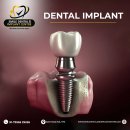 Best Dental Implant Clinic in Secunderabad