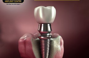 Best Dental Implant Clinic in Secunderabad