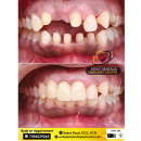 Get Your Perfect Smile: Best Fixed Teeth Services in Ecil, Kapra Secunderabad