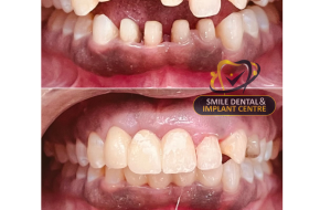 Get Your Perfect Smile: Best Fixed Teeth Services in Ecil, Kapra Secunderabad