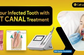 Best Root Canal Treatment Clinic Near Kapra, Secunderabad