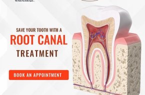 Top Dental Clinic for Root Canal Treatments in Sainikpuri, Hyderabad