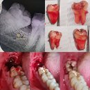 Wisdom Tooth Extraction Cost near me in Hyderabad