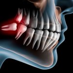 Wisdom Teeth Extraction Cost near A. S. Rao Nagar, Secunderabad